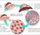 malaria