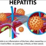 HEPATITIS