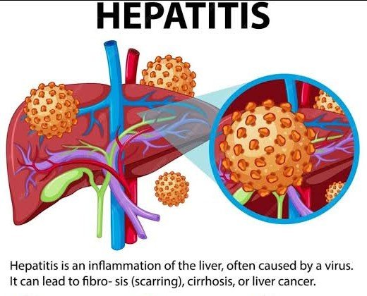 HEPATITIS